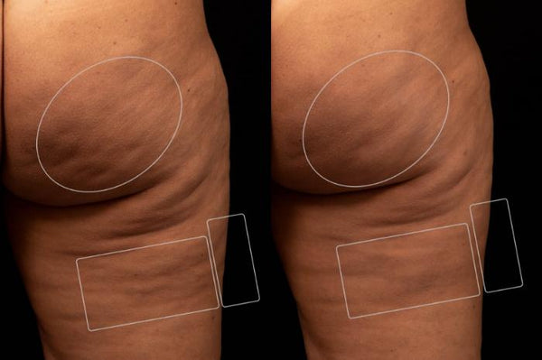 SculptSkin™ Mini | Body Contouring