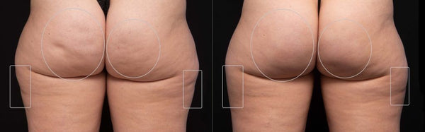 SculptSkin™ Mini | Body Contouring