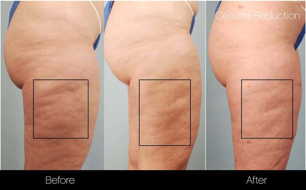 SculptSkin™ Mini | Body Contouring